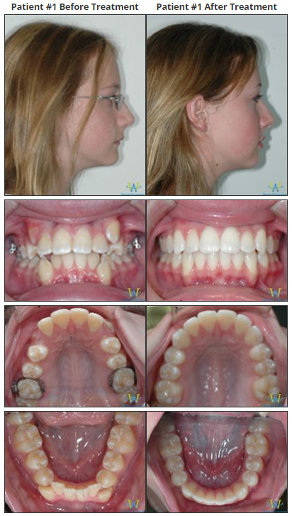 Braces: Before and After Buck Teeth