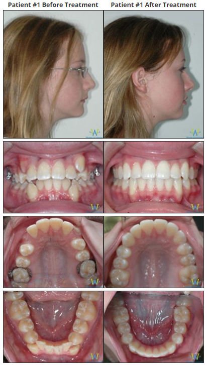 before and after braces overbite profile