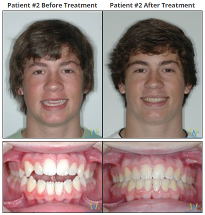 braces before and after open bite