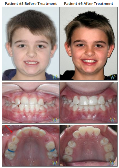 Braces Before & Afters
