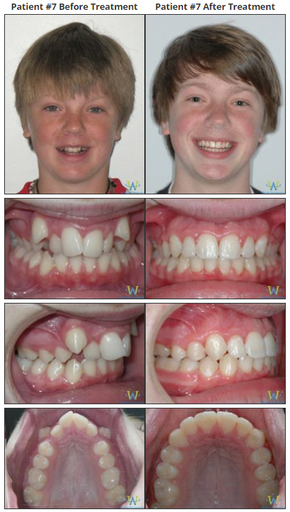 buck teeth before and after braces
