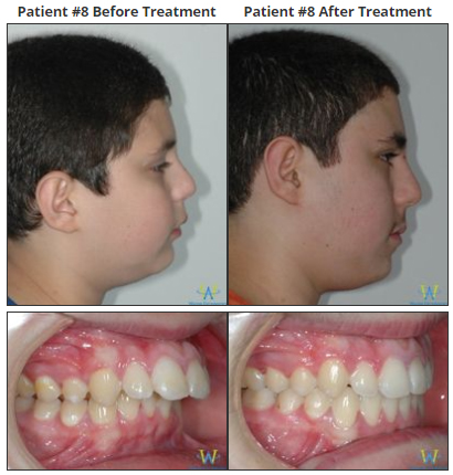before and after braces overbite profile