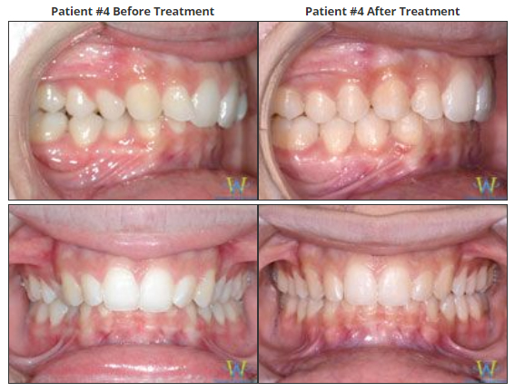 invisalign before and after photos