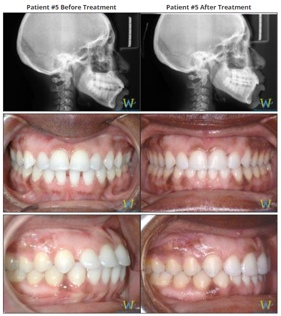 invisalign before and after photos