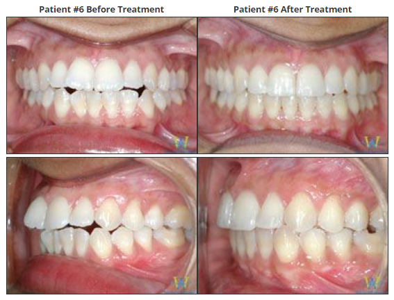 invisalign before and after photos