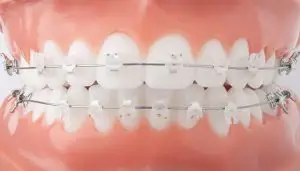 Clear Braces Suwanee - Alpharetta Clear Braces Inovationc