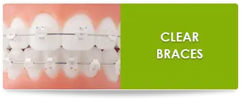Clear braces in suwanee ga