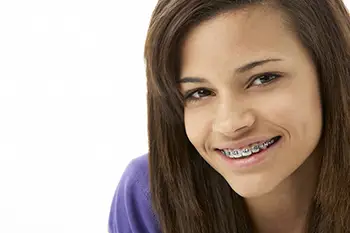 Cumming Ga Braces - Braces &Amp; Invisalign Teen In Suwanee &Amp; Cumming, Ga Suwanee ga braces for teens